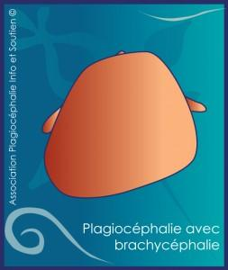 plagiocephalie-4